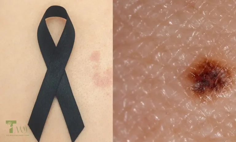Melanoma Uncovered: Your Ultimate Prevention Guide