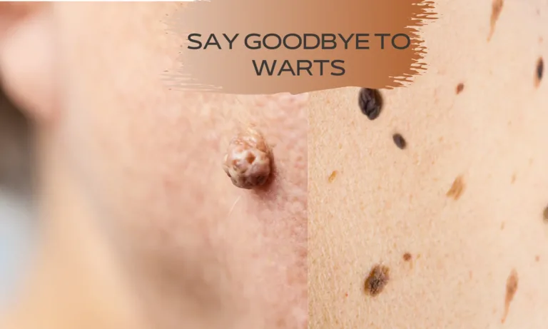 Remove Skin Tags and Warts